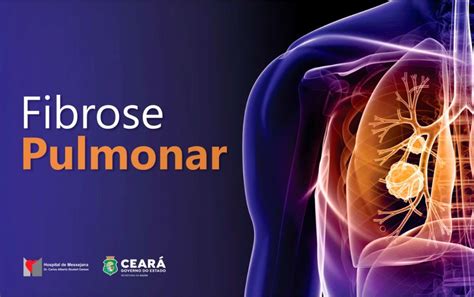 fibrose pulmonar - fibrose pulmonar idiopática